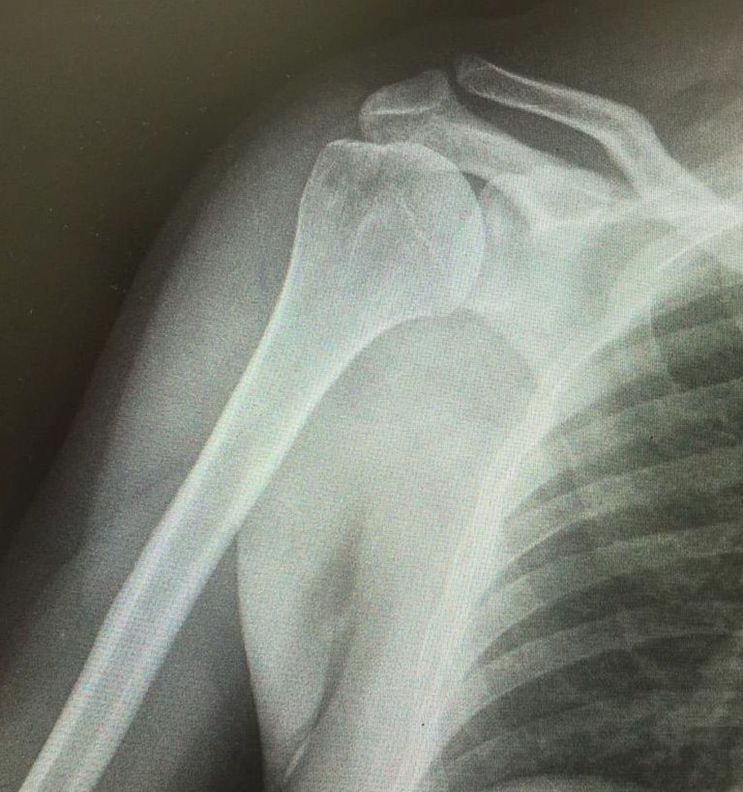 Shoulder x -Ray - MEDizzy