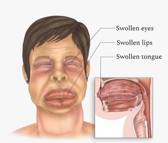 Angioedema