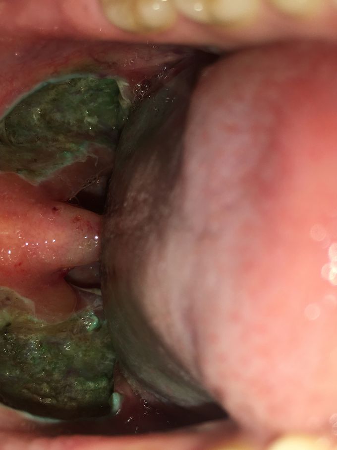 Follow up of previous tonsillectomy