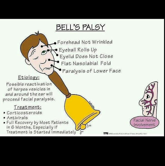 Bell's Palsy