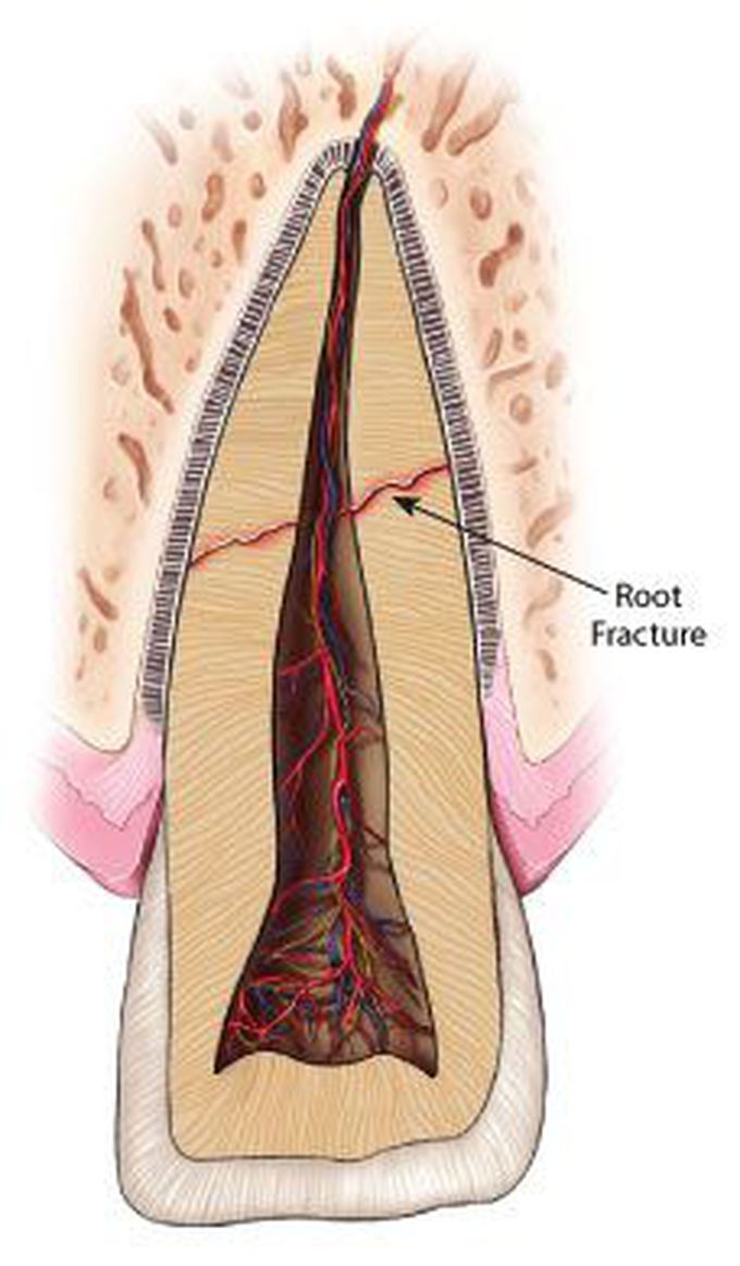 Root fracture