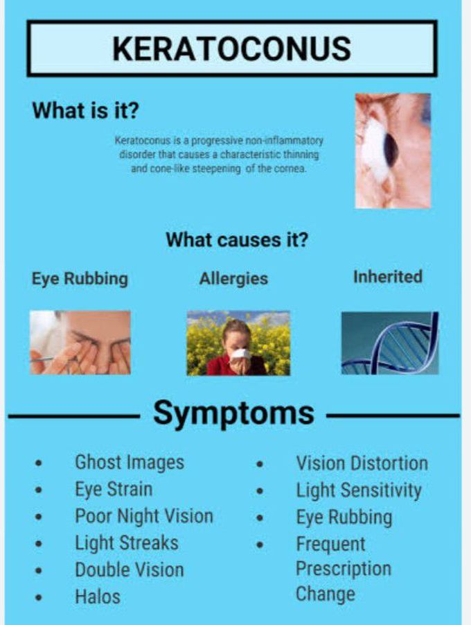 Symptoms of Keratoconus