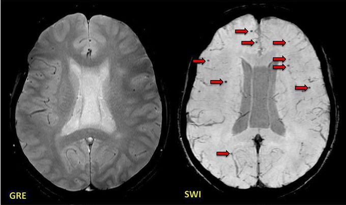 Post-traumatic brain injury showing many more axonal microhemorrhages (arrows) on SWI than on GRE