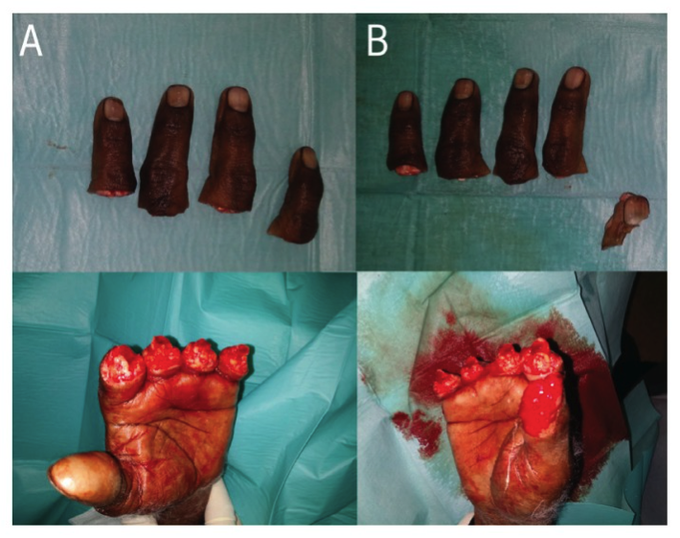 Case Of Amputated Fingers