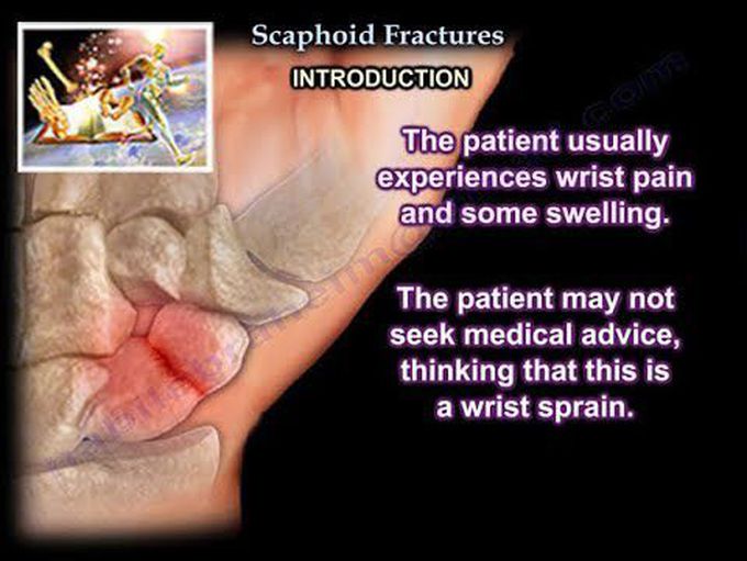 Scaphoid Fractures - Everything You Need To Know - Dr. Nabil Ebraheim