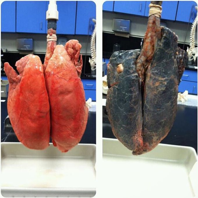 Lungs of a non smoker and a smoker!! 
