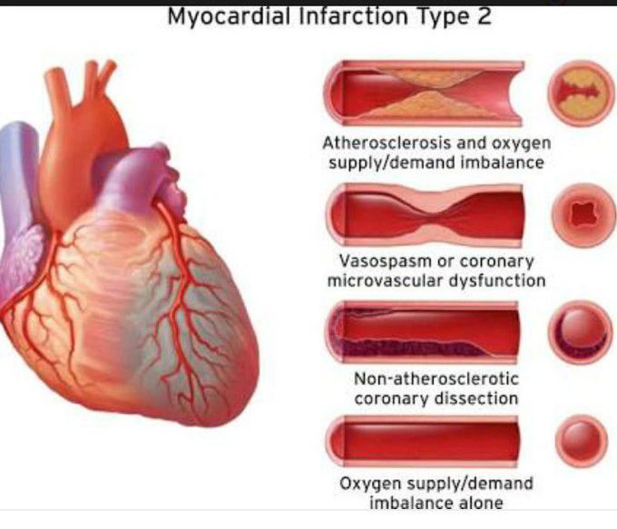 Myocardial infarction