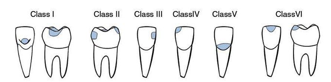 GV Black Classification of Caries