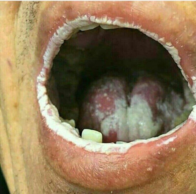 Pseudomembranous candidiasis