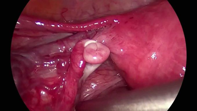 Laparoscopic sterilization with Falope ring and Filshie clip