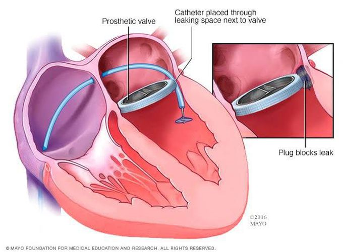 Treaent of Mitral regurgitation