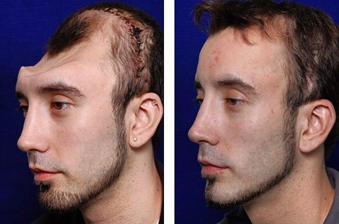 Incredibly well-performed skull deformity reconstruction giving back new life quality