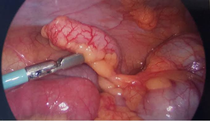 Acute Appendicitis