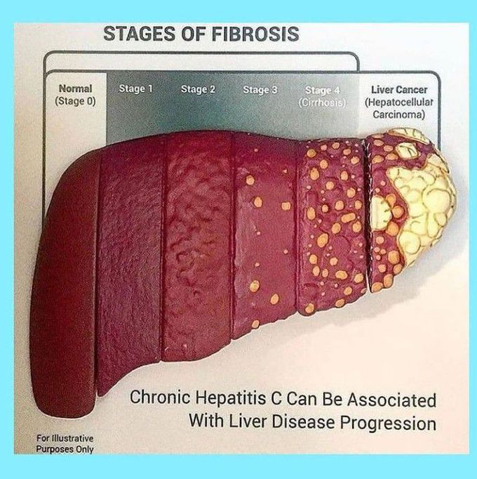 Stages of fibrosis