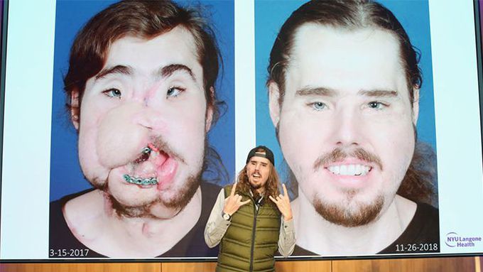 Face Transplant Patient Reveals New Look 10 Months After Surgery