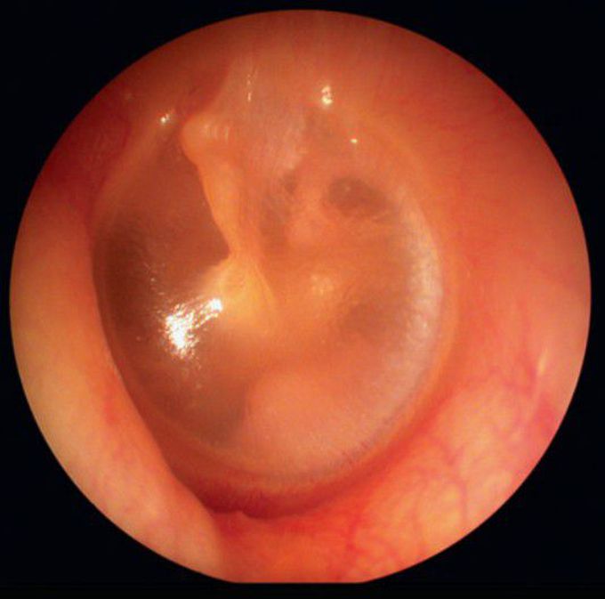 Normal left tympanic membrane viewed through an otoscope.