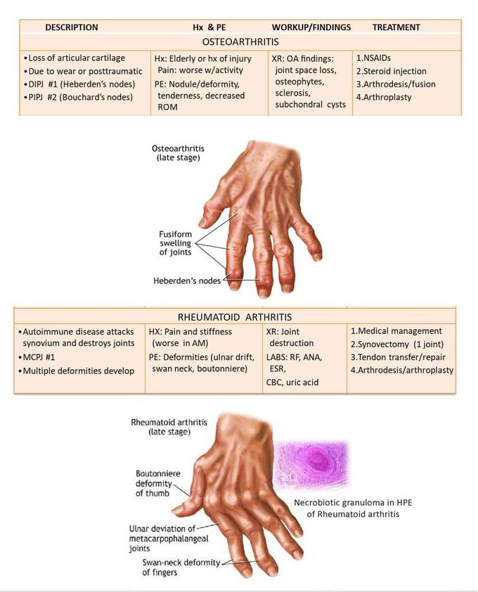 Connective tissue disorder