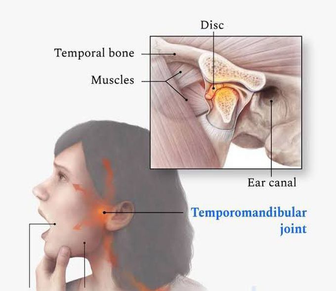 TMJ DISORDER Symptoms