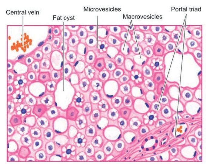 Fatty liver (alcoholic steatosis).