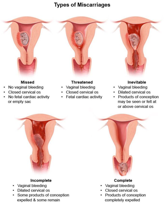 Types of miscarriage