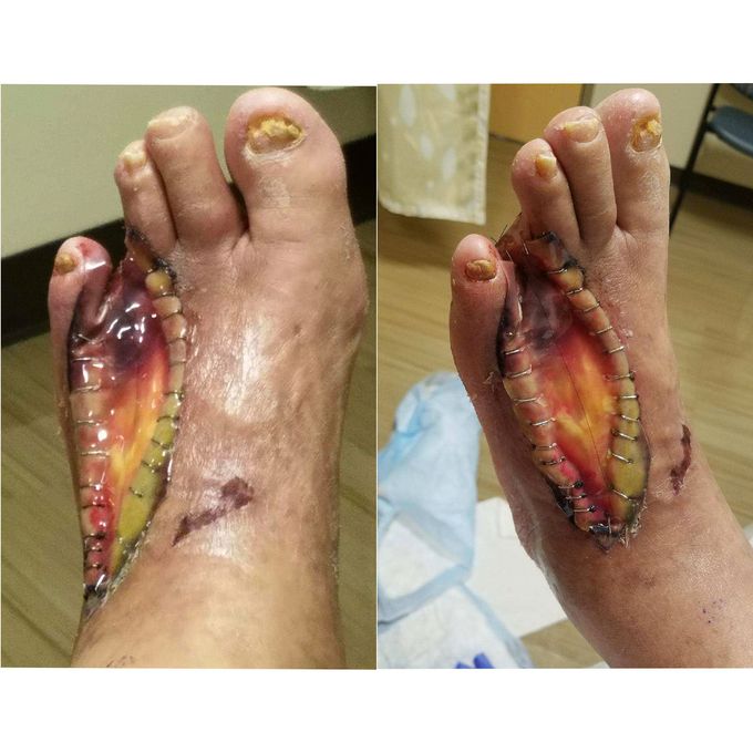 This patient had gotten his toe removed because of diabetes!!
