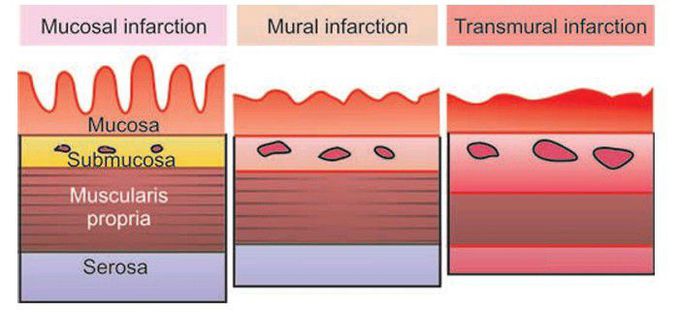 Ischemic bowel disease