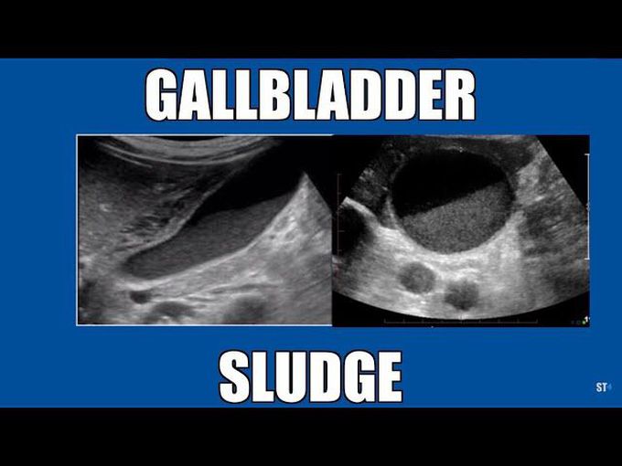 Symptoms of gall bladder sludge