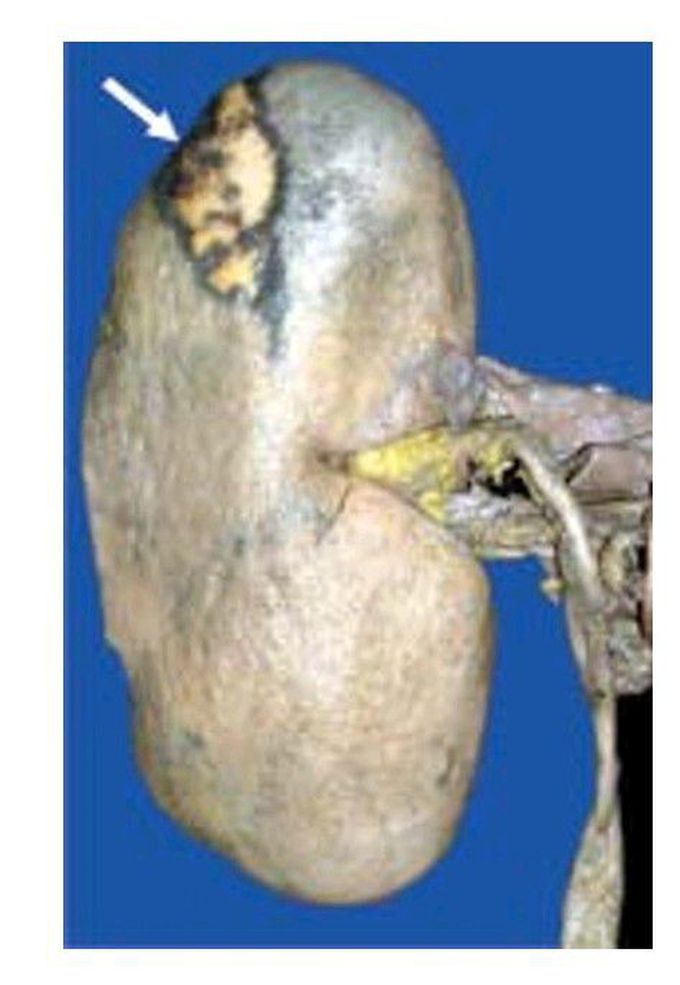 Infarct kidney.