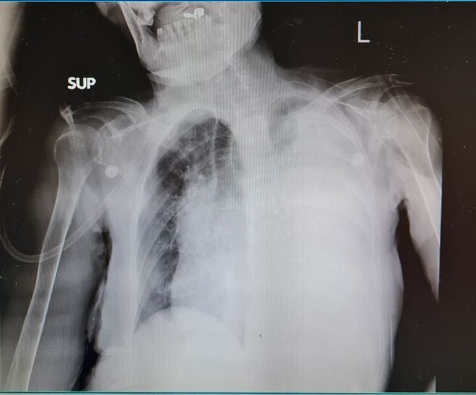 Huge pleural effusion