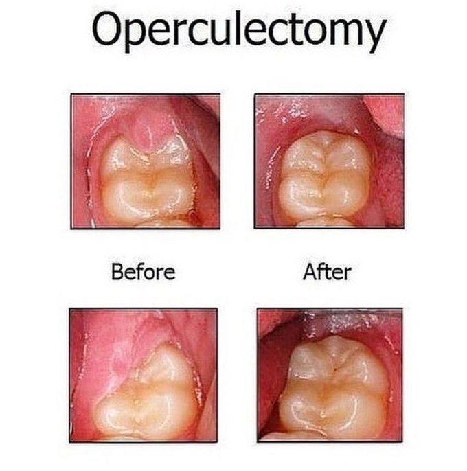 Operculectomy