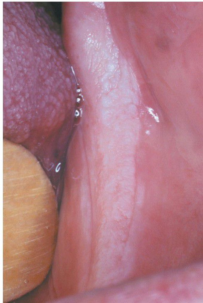 Frictional Keratosis