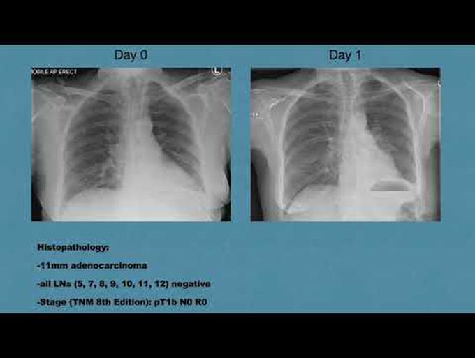Robotic Left Lower Lobe Split Lateral (S9) and Posterior (S10) Basal Bisegmentectomy