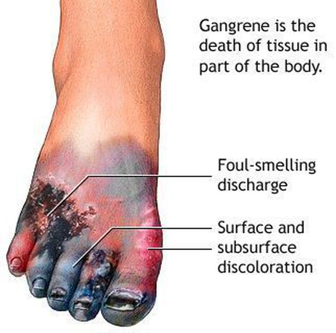 Gangren Morphology