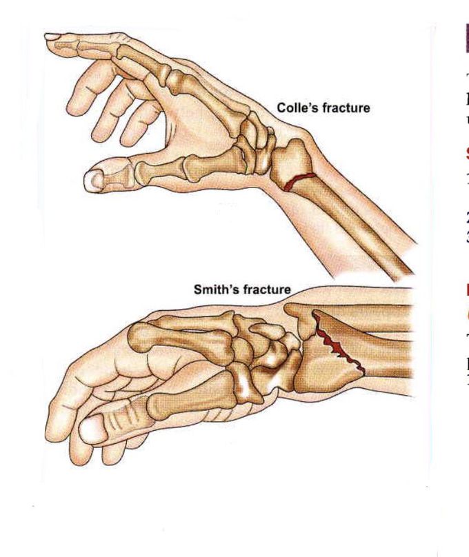 Fracture of radius