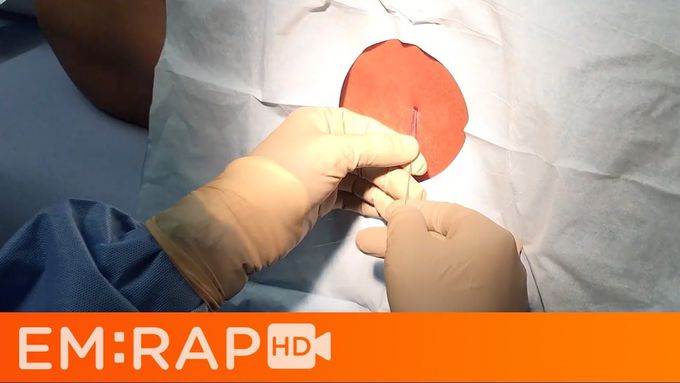 How to Perform a Lumbar Puncture