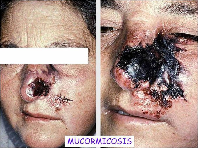 Mucormycosis