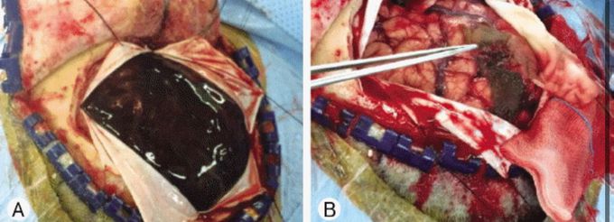 Subdural Hematoma