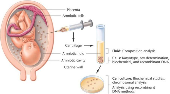 Shown here is a procedure called amniocentesis