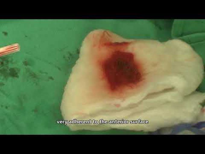 Surgical Repair for Anterior and Inferior Ventricular Aneurysms