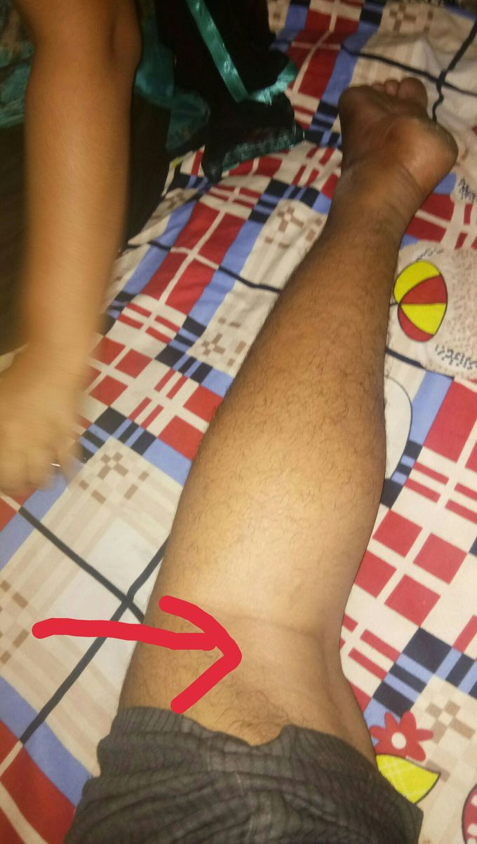 Pain behind knee