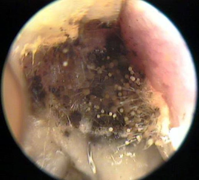 OTOMYCOSIS!!!