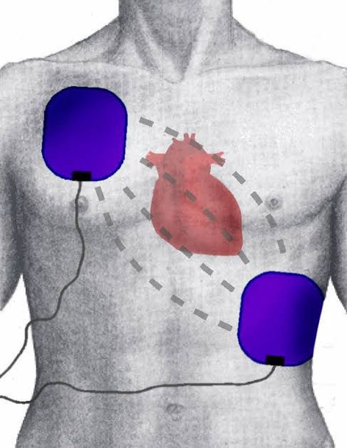 What is defibrillation?