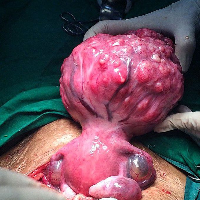 Surgical excision of a massive uterine fibroid!