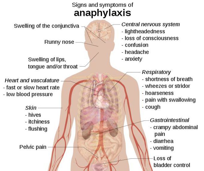 Anaphylaxis Sign and Symptoms