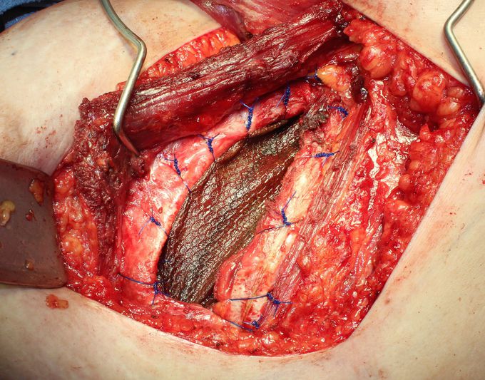 Anterior Thoracic (Chest Wall) Lung Herniation and Repair