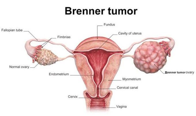 Brenner Tumor