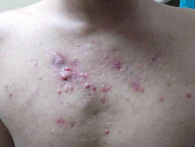 Derma cases. Diagnosis?