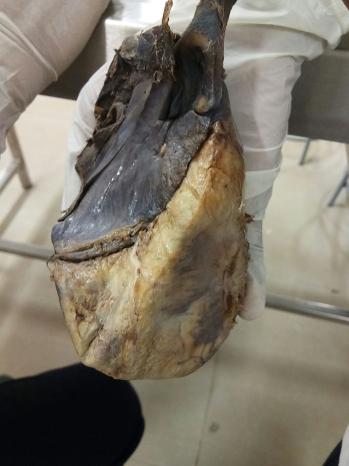 heart