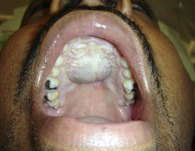 Median palatal cyst