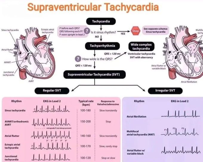 Supraventricular Tachycardia